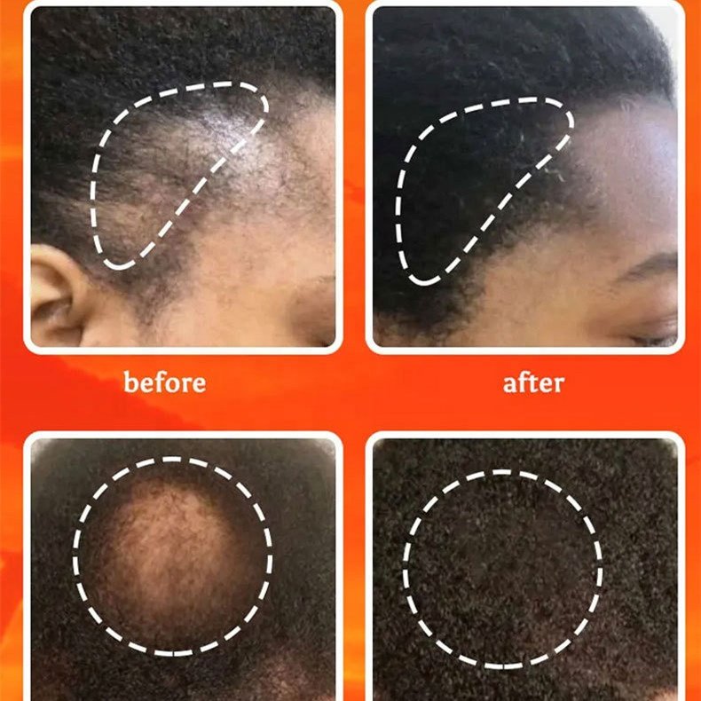CHEBE anti loss regrowth treatment products promoting growth hair care set sulfate free shampoo and conditioner