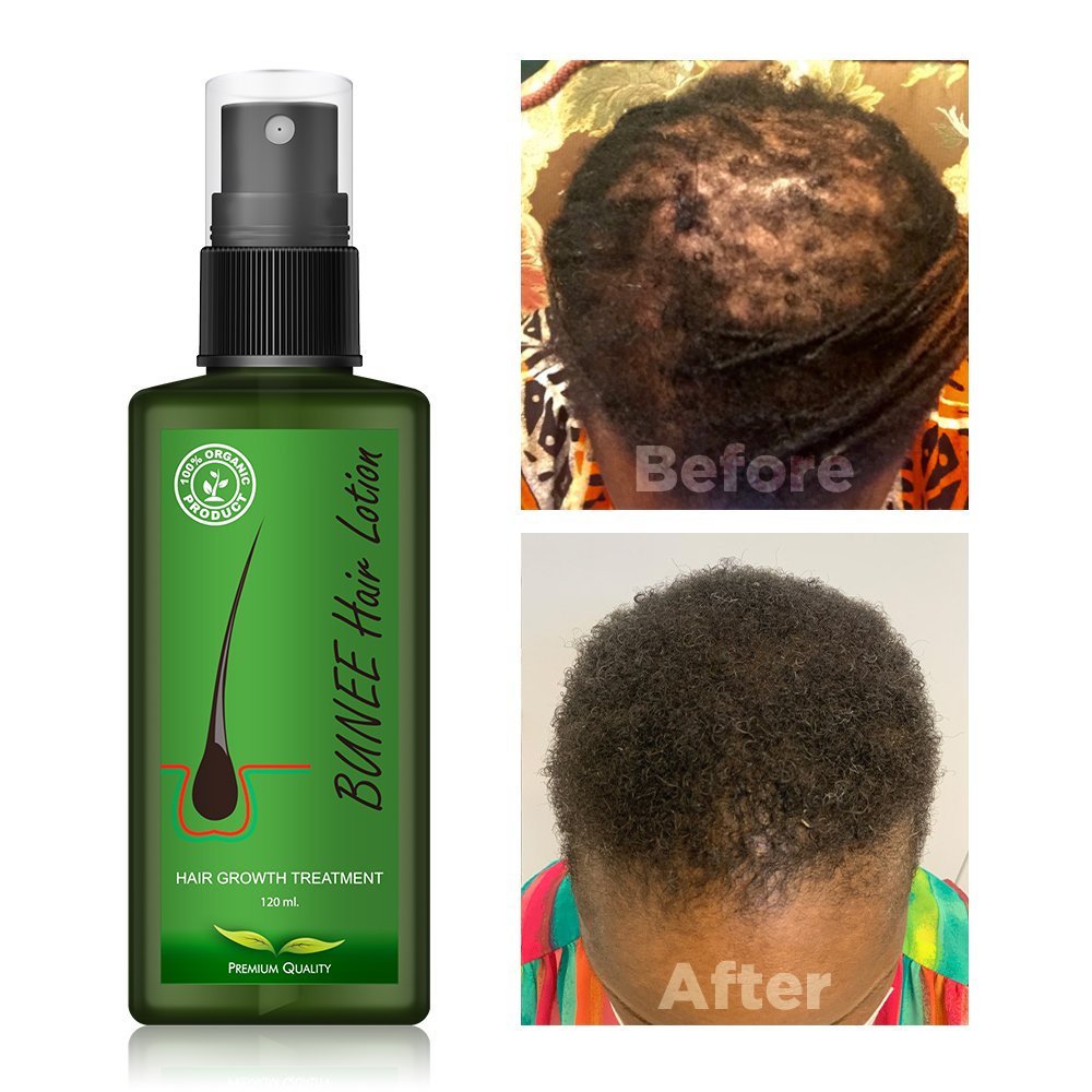 Hair Regrowth Treatment Serum Thailand Hair Regrowth Tonics Scalp Serum Strengthening Hair Growth Lotion Spray