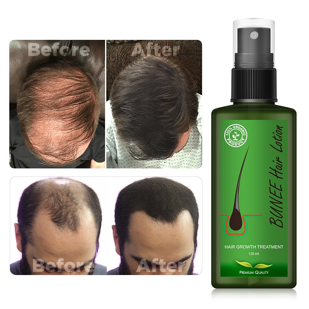 Hair Regrowth Treatment Serum Thailand Hair Regrowth Tonics Scalp Serum Strengthening Hair Growth Lotion Spray