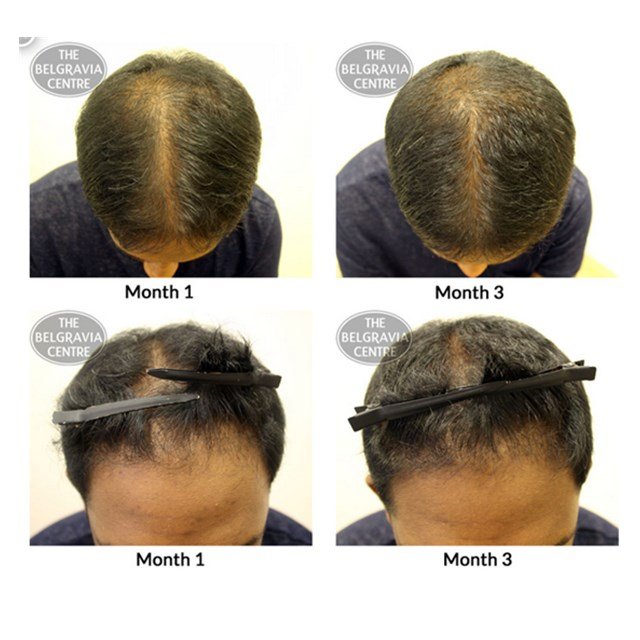Favorite hair tonic anti hair loss hair growth stimulator YUDA pilatory or private label
