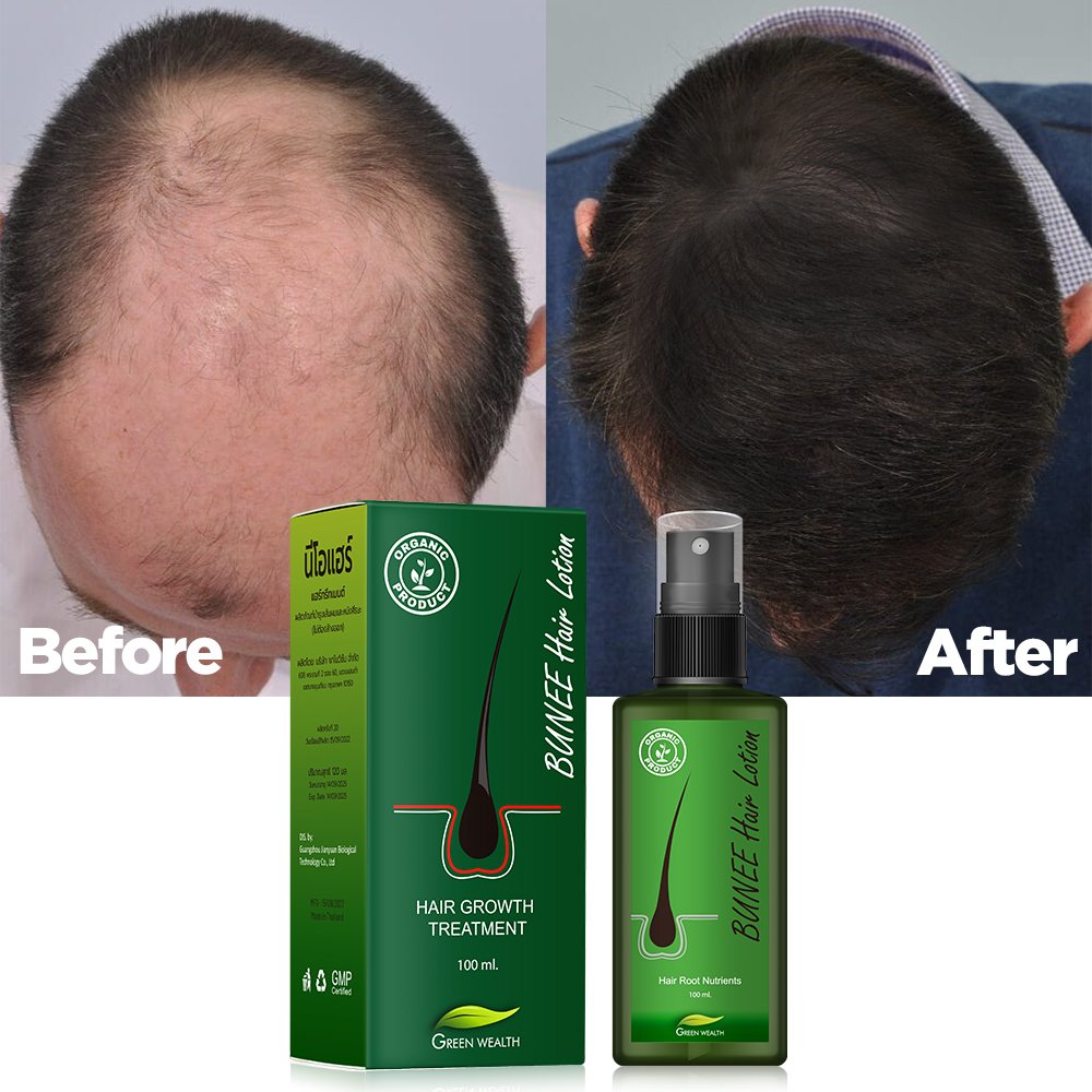 Hair Regrowth Treatment Thailand Hair Growth Tonics Biotin Hair Loss Solution Spray