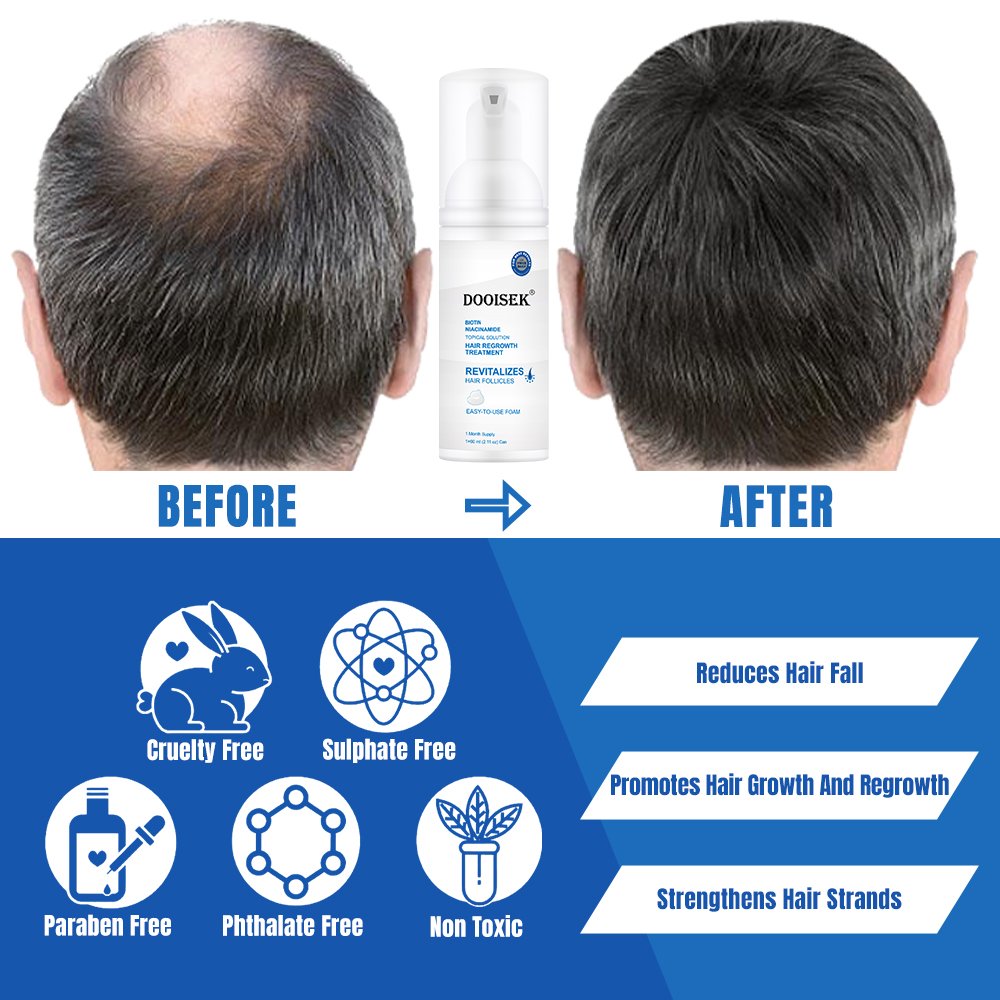 Hot Products Men's Topical Solution Anti- Hair Loss Treatment Hair Regrowth Oil Biotin Serum kirland hair growth foam