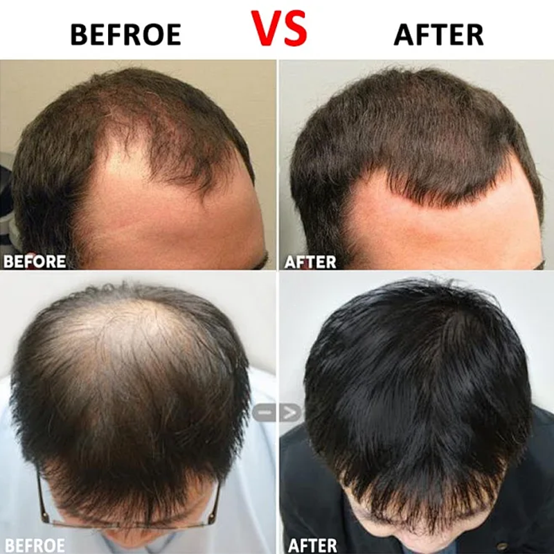 Herbal shampoo for men and women to control oil and prevent hair loss. Ginger shampoo is used for hair loss and hair loss
