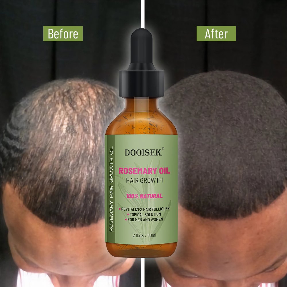 Wholesale Herbals Hair Tonic Liquid Hair Regrowth Anti Hairloss Serum Hair Growth Essential Oil Spray OEM
