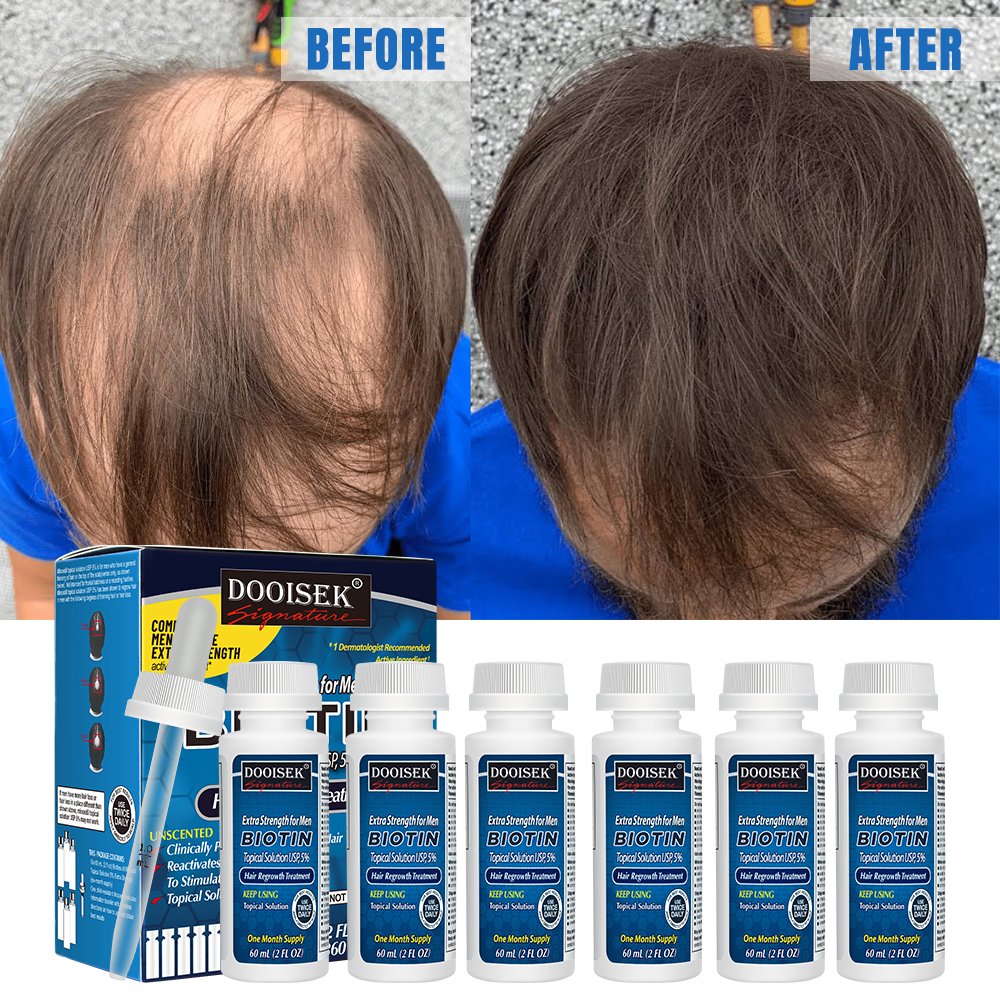 Kirland 5% Hair Loss Treatment Regrowth Serum Oil Saw Palmetto Hair Growth Serum with Dropper beard growth serum