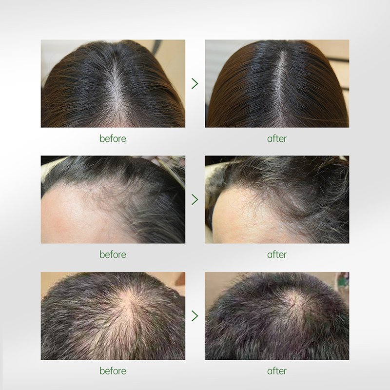 PURC Hair Growth Products Ginger Essence Natural Regrowth Oil for Men Hair Loss Care Scalp Treatment Beauty Health
