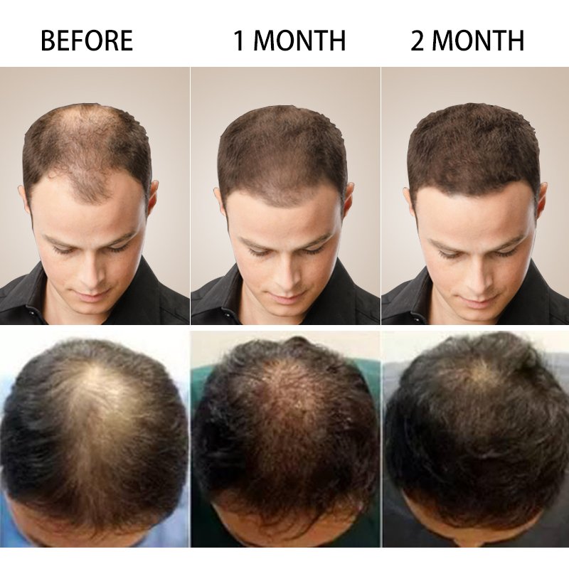 PURC Hair Growth Products Ginger Essence Natural Regrowth Oil for Men Hair Loss Care Scalp Treatment Beauty Health