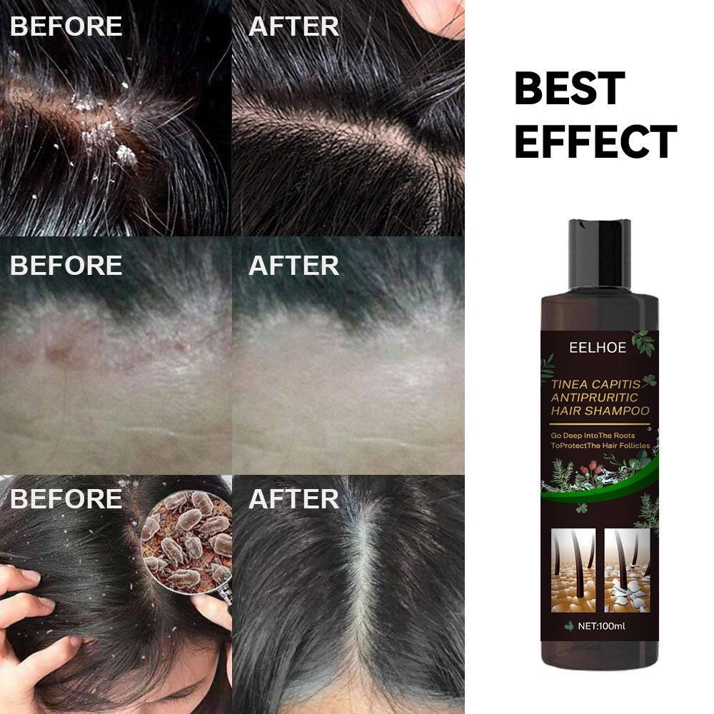 EELHOE 100% Natural Moisturizing Anti Itching Remove Tinea Capitis Mites Plant Extract Herbal Anti-Dandruff Shampoo