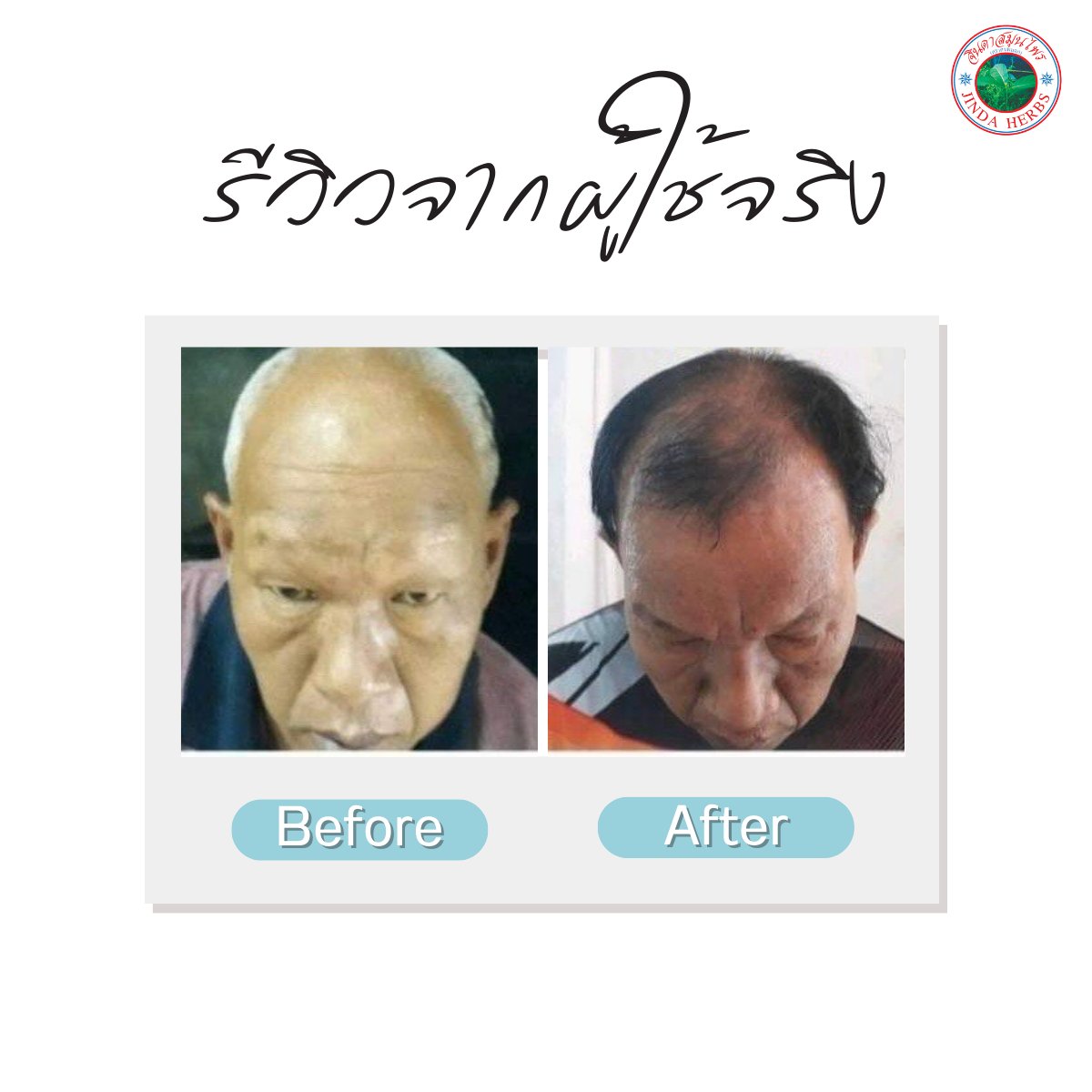 Hair Growth Portable Anthocyanin Herbal Serum Hair Regrowth Tonic for Baldness and Hair Loss Treatment Promotes