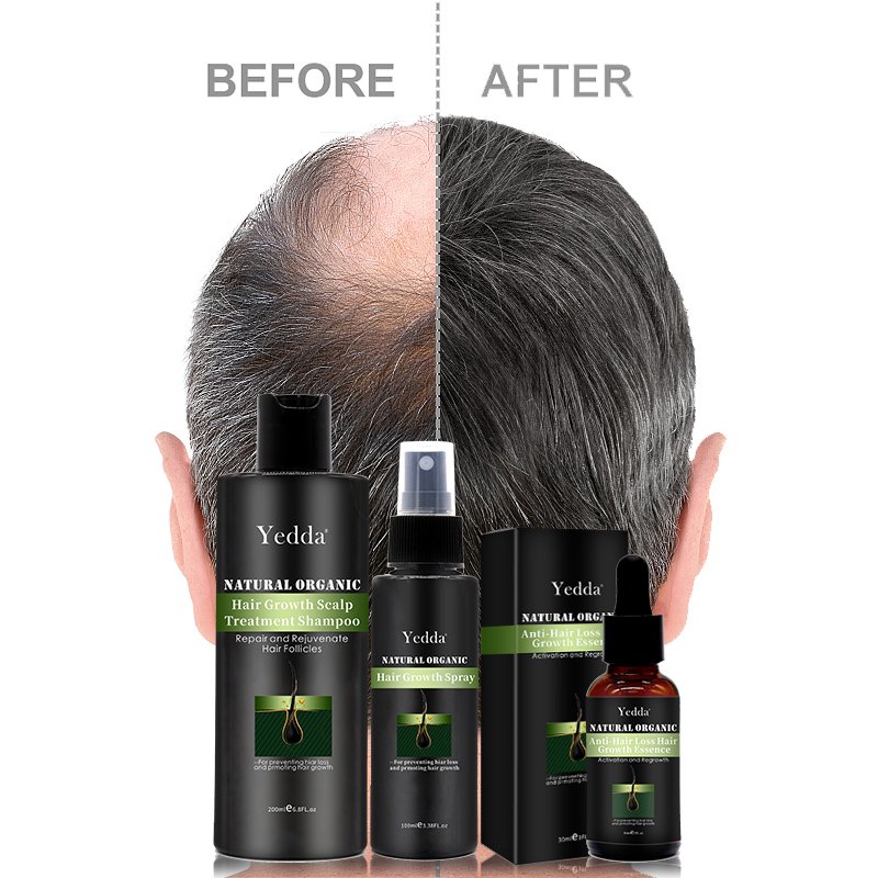 Hair Regrowth Essence Anti-Hair Loss Treatment Growth Oil Professional Fast Plant Extract Shampoo