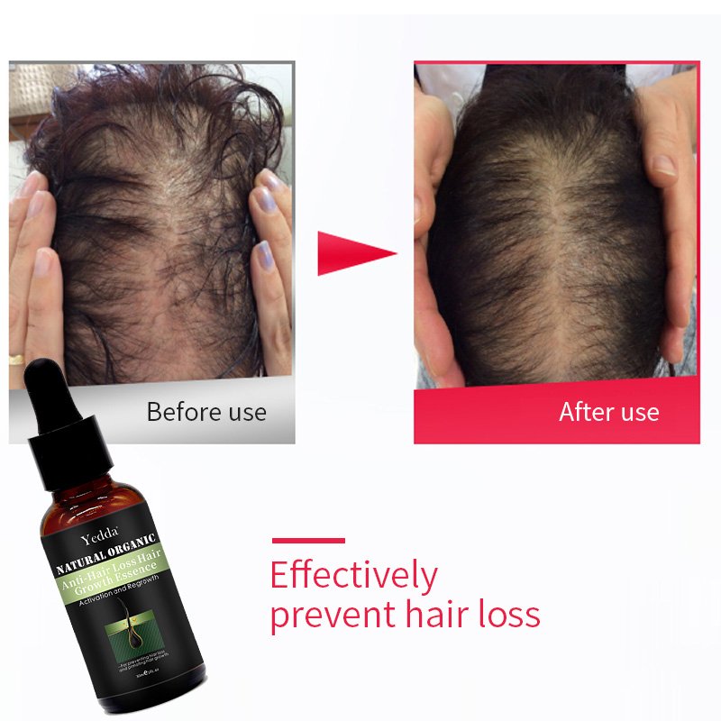 Hair Regrowth Essence Anti-Hair Loss Treatment Growth Oil Professional Fast Plant Extract Shampoo