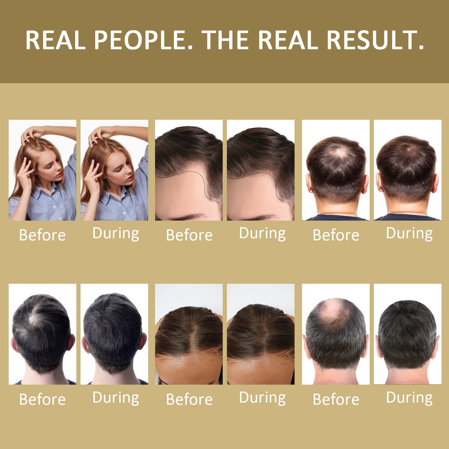 OEM/ODM Hair Growth Sulfate Free Hair Loss Prevention DHT Blocker Anti-Hair Loss Shampoo and Conditioner Kit