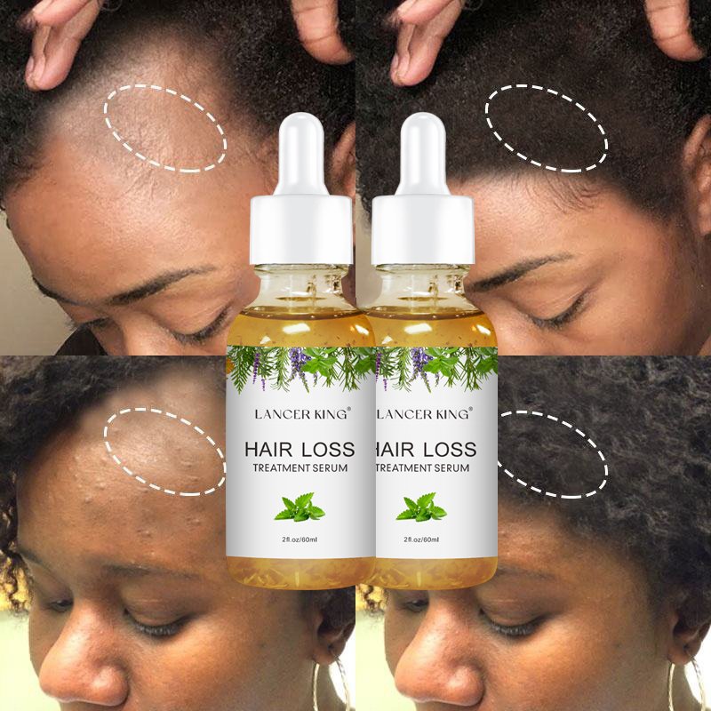 Hair Growth Oil Hair Treatment Repair Dry Damaged Nourish Scalp Smooth Regrowth Thicken Strengthening Dense Hair Essence
