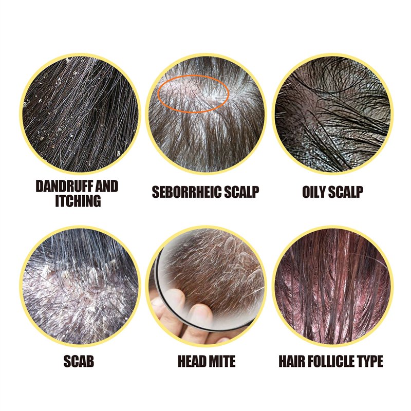 South Moon sulfur hair dandruff shampoo refreshing itch relieving tinea capitis reducing best hair seborrheic scalp shampoo