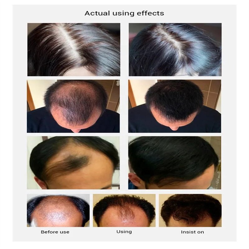 OEM Special Formula 60ml hair regrowth tonics Vitamin hair growth foam Serum For Men Hair Regrowth Treatment