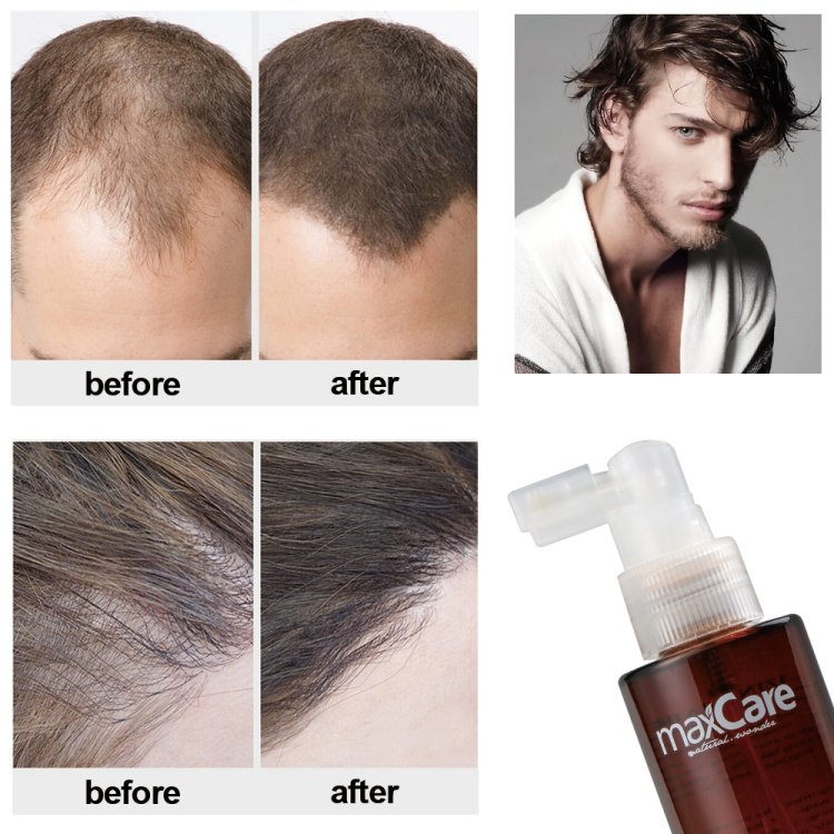 Maxcare Guangzhou Factory Norish Scalp Hair Loss Treatment Ginger Material Hair Tonic For Hair Grow