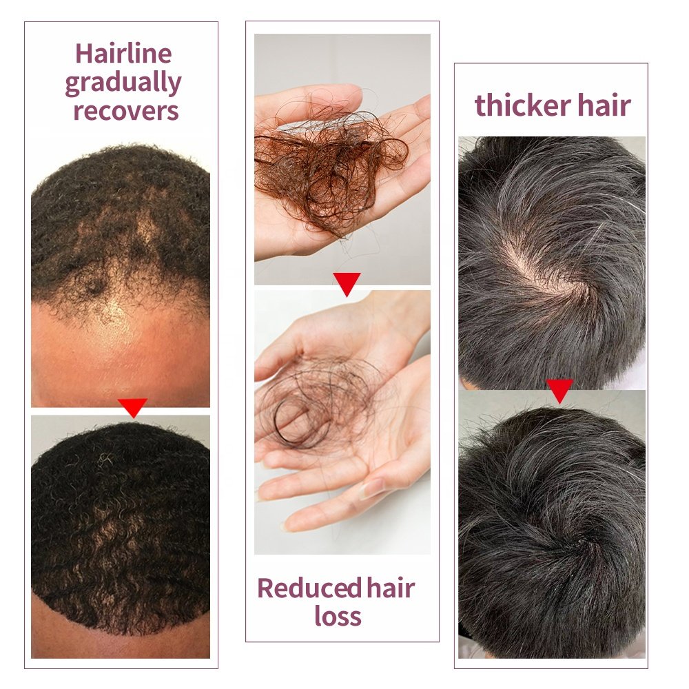 OCCA Private Label Wholesale Natural Organic Scalp Vegan Hair Care Loss Treatment Argan Castor Red Onion Hair Growth Oil Serum