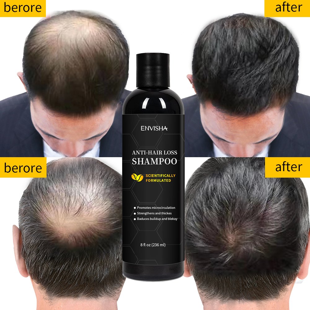 Eco Friendly Hair Care Product Hair Regrowth Shampoo Prevents Hair Loss Shampoo And Conditioner
