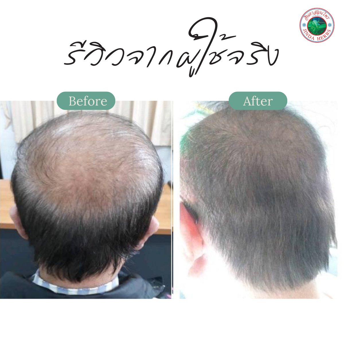 250ml Portable Anthocyanin Herbal Serum Hair Regrowth Tonic for Baldness and Hair Loss Treatment Promotes Healthy Hair Growth