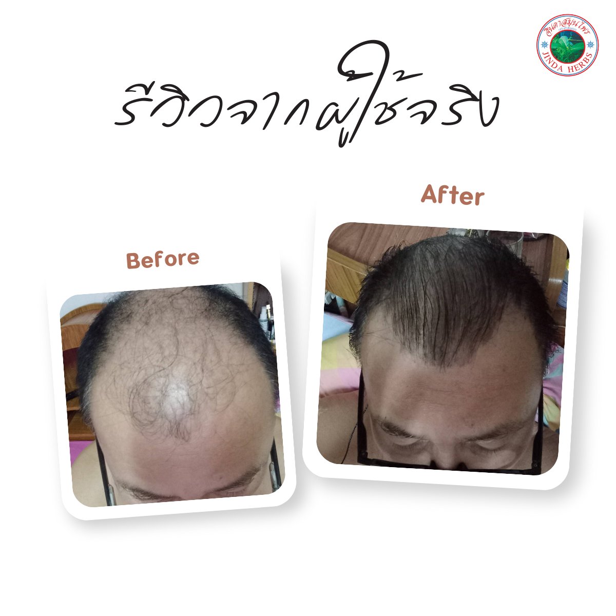 250ml Portable Anthocyanin Herbal Serum Hair Regrowth Tonic for Baldness and Hair Loss Treatment Promotes Healthy Hair Growth