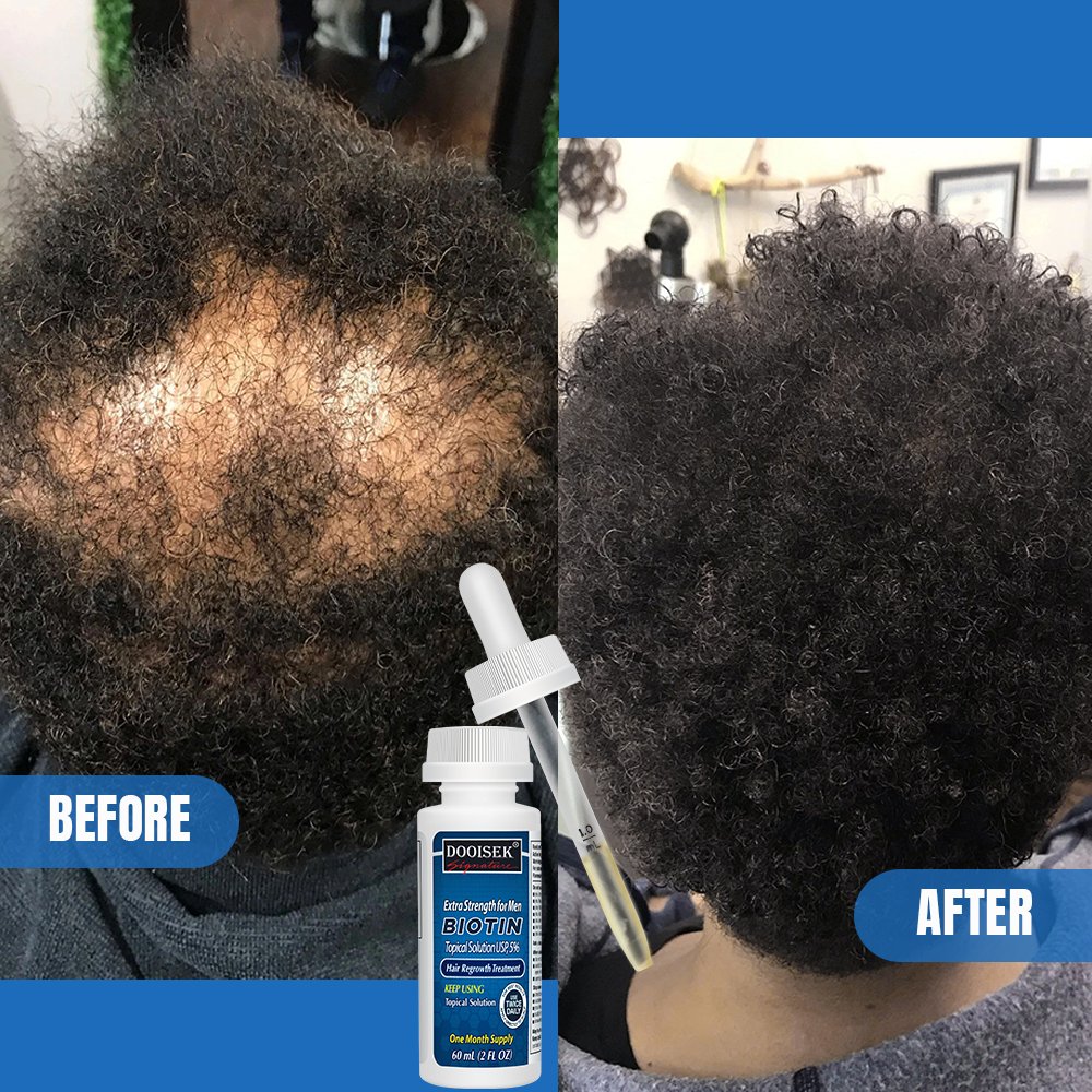Quality Assurance 60ML Hair tonic Hair Growth Serum Kit Pousse Cheveux Anti Hair Loss kirland 5% Aromatherapy Essential Oils