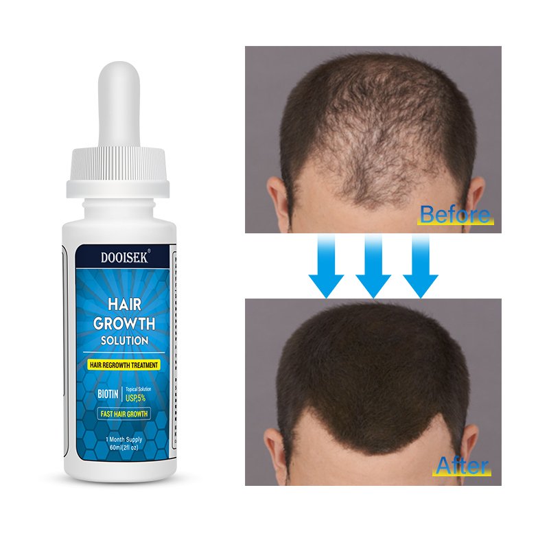 Customize Hair Products Organic Hair Loss Regrowth Serum For Black Women Fast Hair Growth
