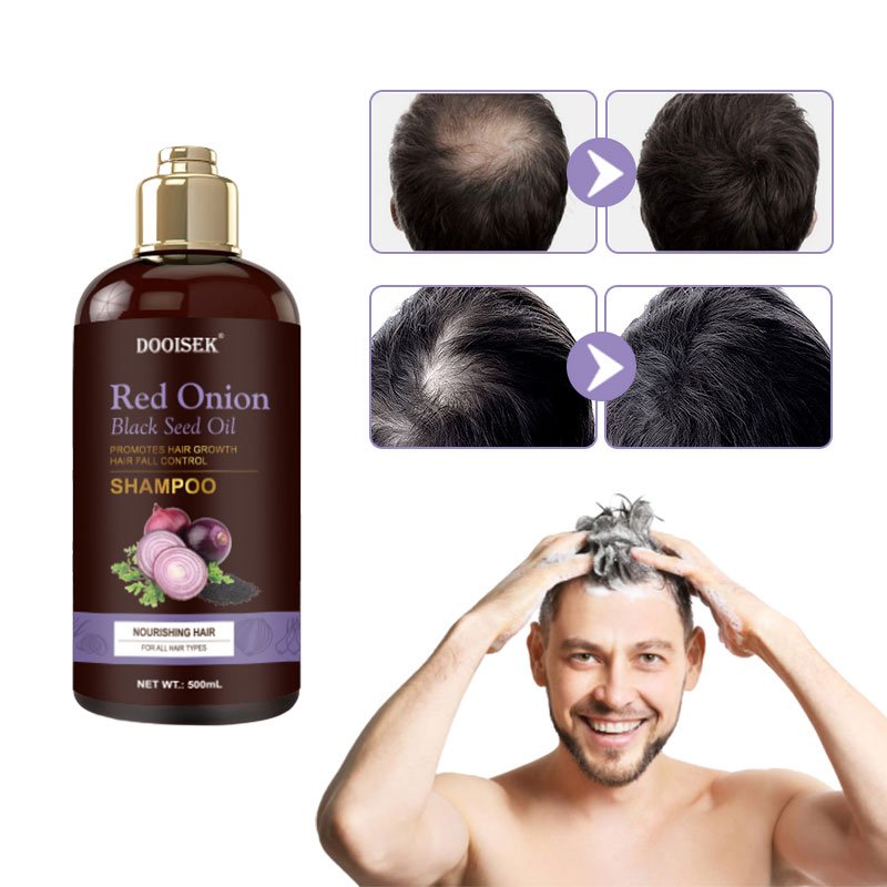 Dooisek 100% safe organic and paraben free hair treatment red onion shampoo for hair growth