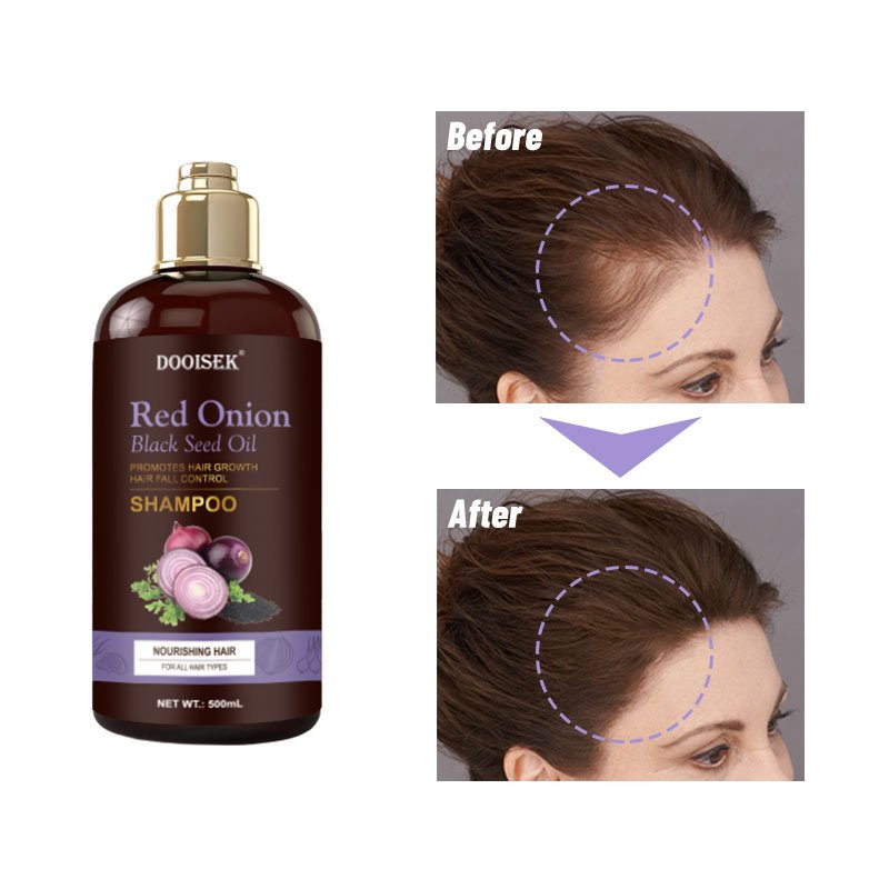 Dooisek 100% safe organic and paraben free hair treatment red onion shampoo for hair growth