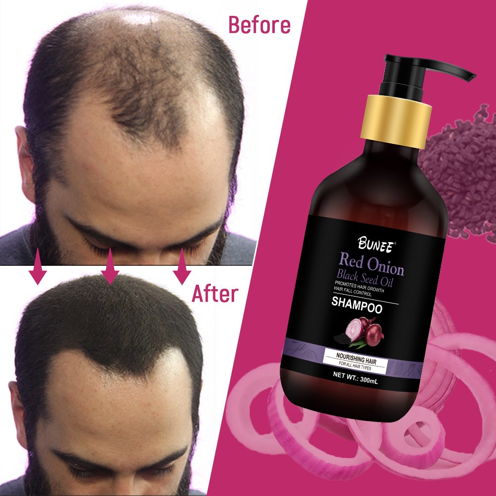 New Product Customization Natural essences Anti Hair Loss Thinning Hair Growth Shampoo Onion Black Seed Oil Shampoo