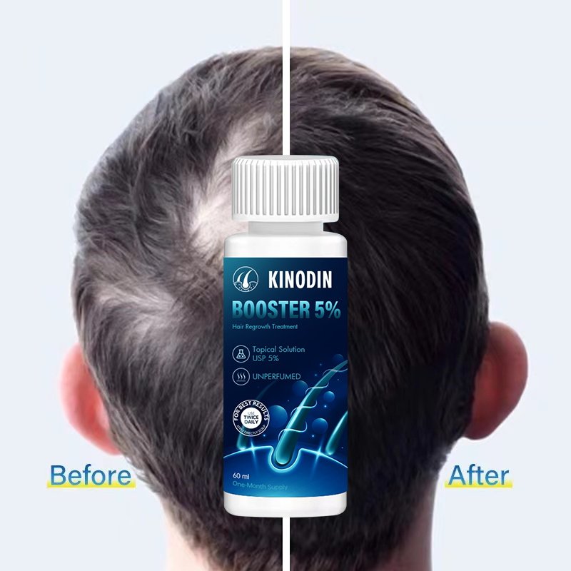 KINODIN Super Fast Hair Growth Serum Tonic hair growth 60ml 5% Prevents Hair Loss Russia xinoxin Growth Serum