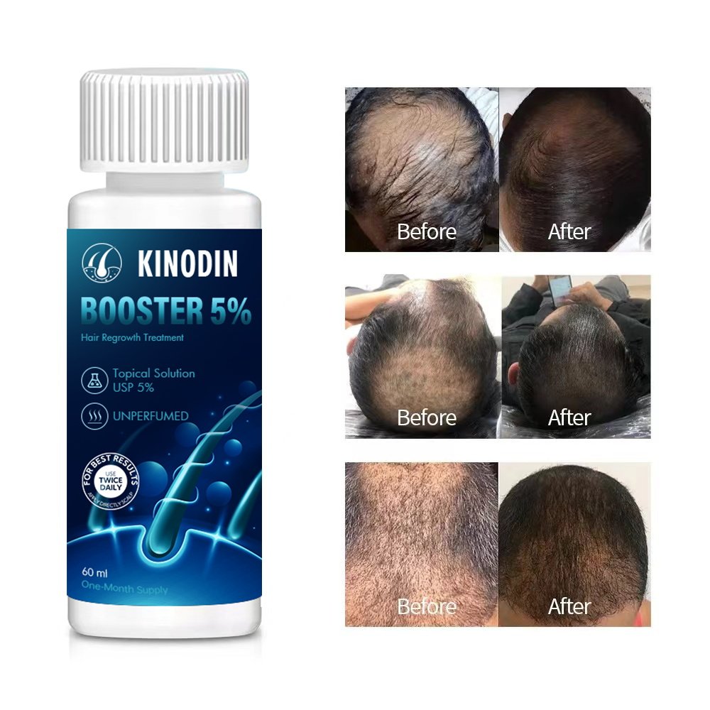 KINODIN Super Fast Hair Growth Serum Tonic hair growth 60ml 5% Prevents Hair Loss Russia xinoxin Growth Serum