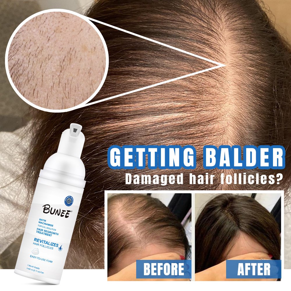 Men's Topical Solution Anti- Hair Loss Rogain Treatment Hair Regrowth Oil Biotin Serum hair growth foam