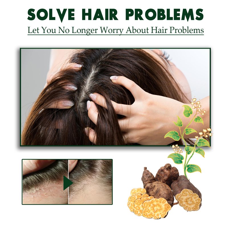 South Moon tinea capitis anti pruritic hair shampoo seborrheic dermatitis psoriasis itch relieving dandruff removing shampoo