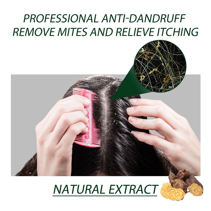 South Moon tinea capitis anti pruritic hair shampoo seborrheic dermatitis psoriasis itch relieving dandruff removing shampoo