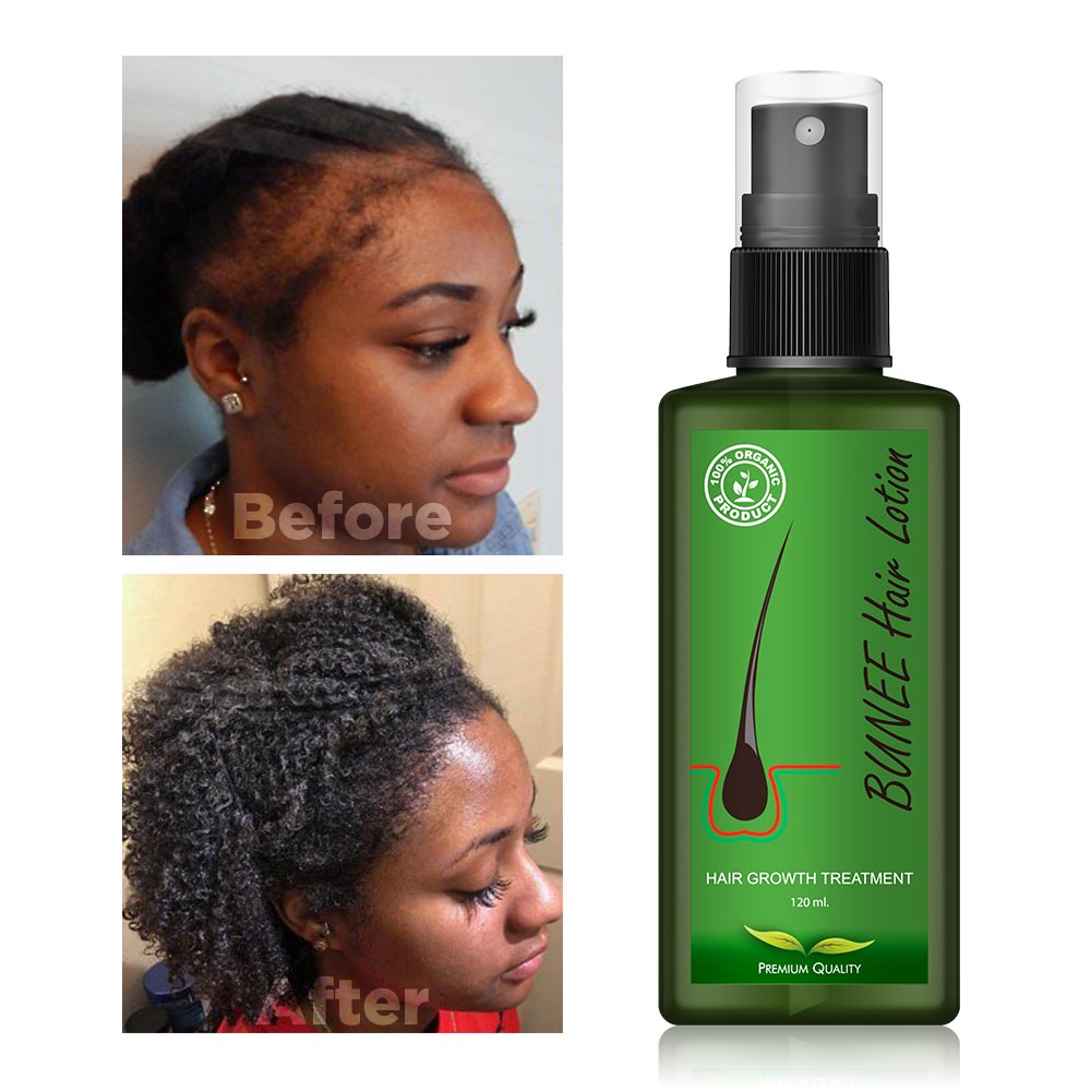 30ml Hair Loss Treatment Serum Hair Oil Nutrient Solution Organic Biotin Growth Serum Hair Growth Oil