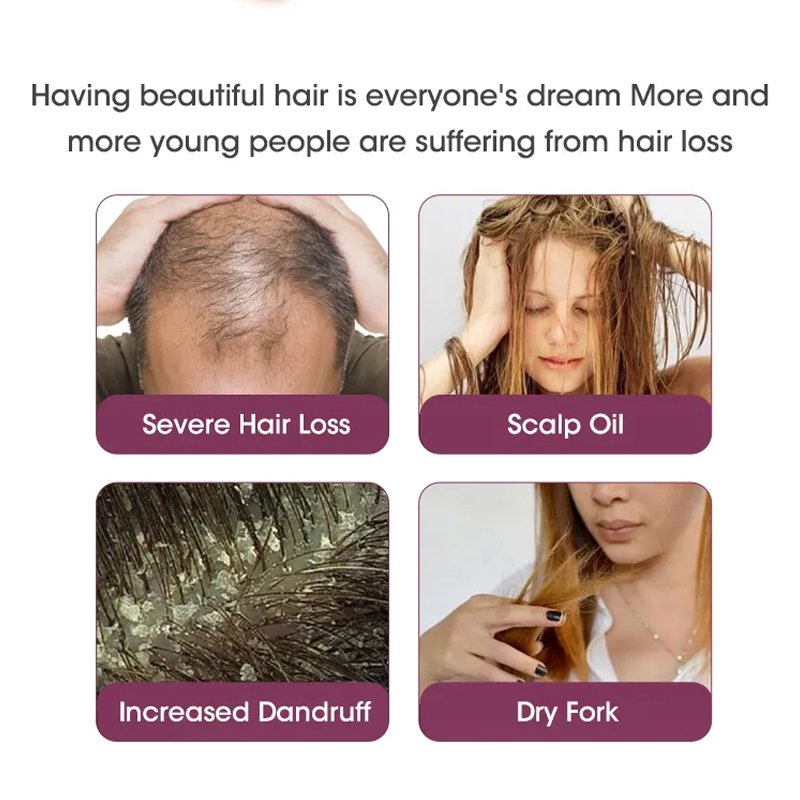 Onion biochemical rosemary shampoos to remove dandruff and repair firing dry dry hair, essential oil hair mask nursing set