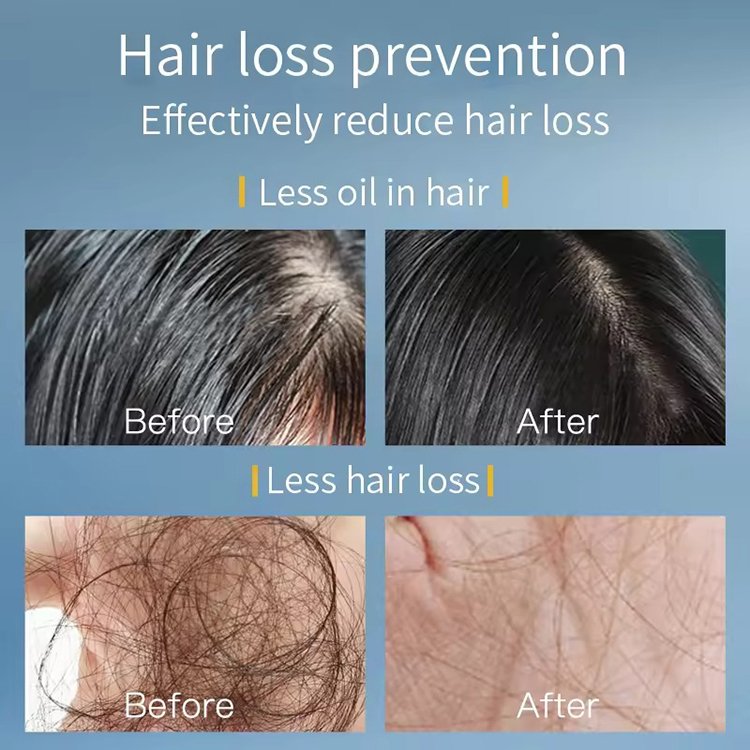hair loss treatments shampoo for baldness hair growth professional hairloss shampoo