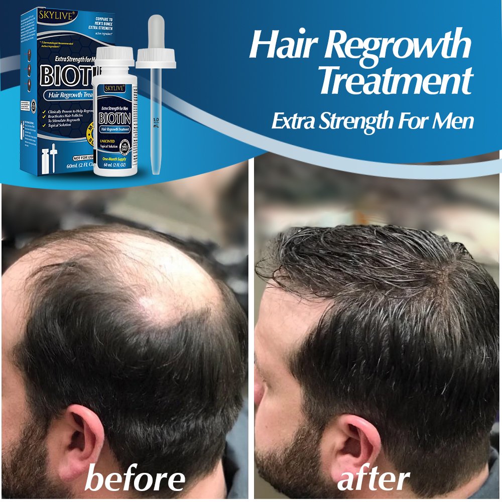 OEM 60ml Fast Hair Regrowth Serum Hair Growth Tonic Treatment For Men And Women