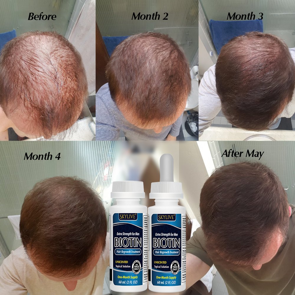 OEM 60ml Fast Hair Regrowth Serum Hair Growth Tonic Treatment For Men And Women