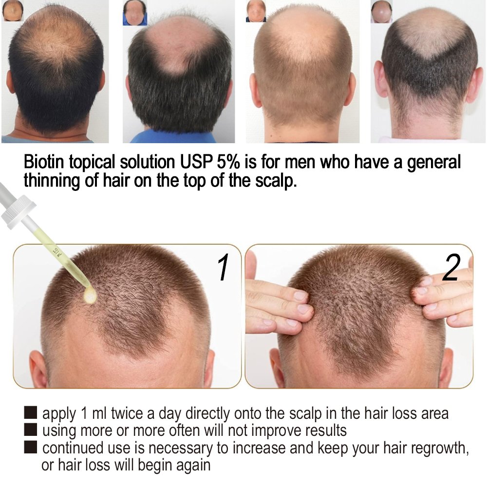 OEM 60ml Fast Hair Regrowth Serum Hair Growth Tonic Treatment For Men And Women