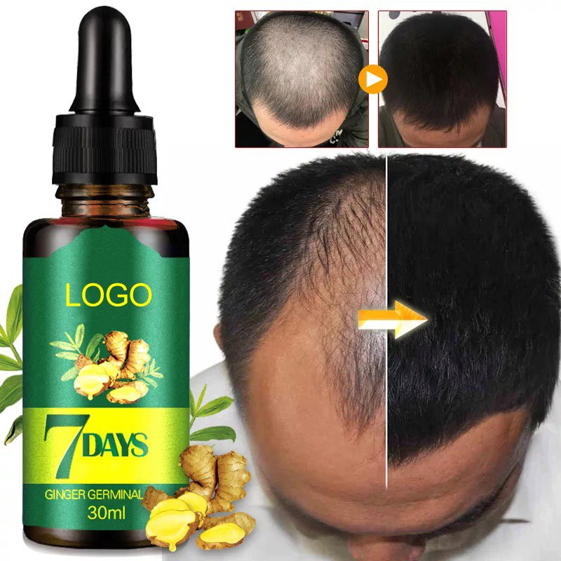 hair regrowth essence Hair Loss Treatment Anti Balding Natural Remedies Ginger Germinal Oil Hair Growth Oil