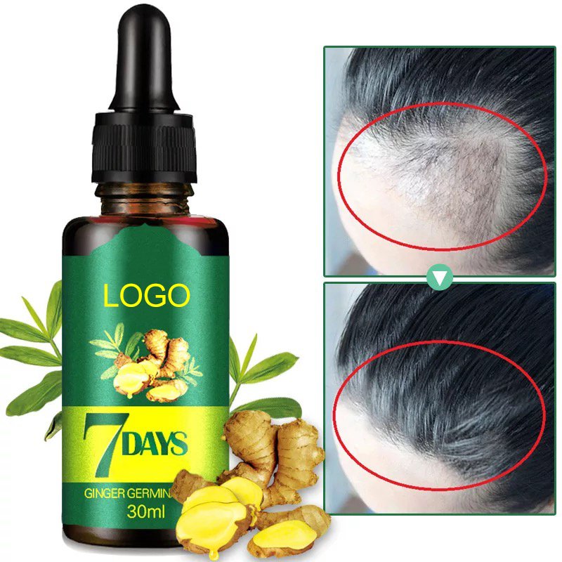 hair regrowth essence Hair Loss Treatment Anti Balding Natural Remedies Ginger Germinal Oil Hair Growth Oil