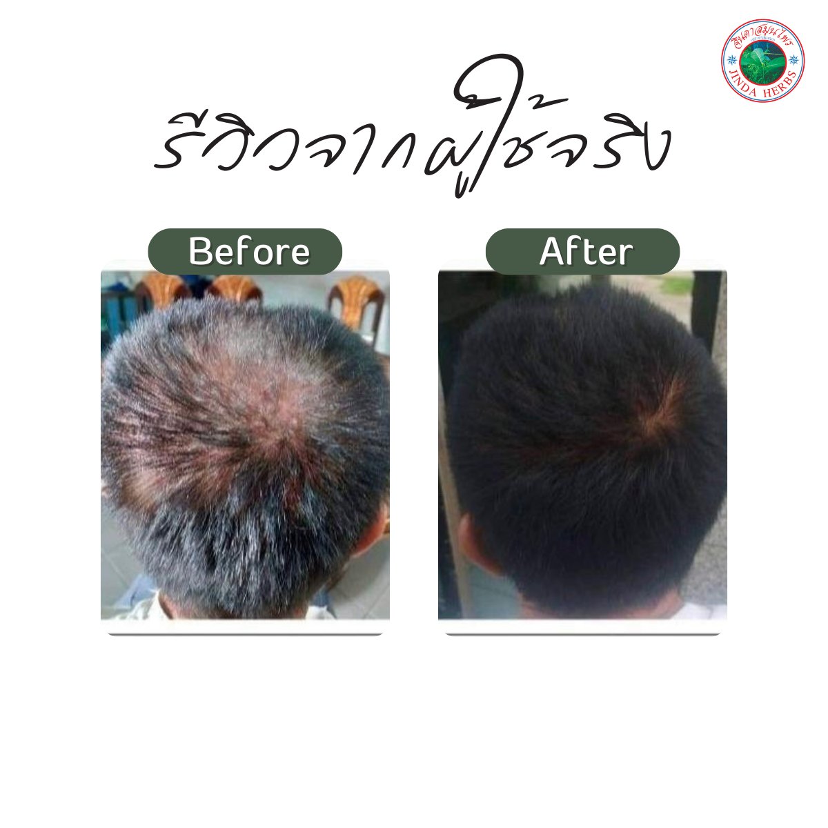 250ml Portable Anthocyanin Herbal Serum Hair Regrowth Tonic for Baldness and Hair Loss Treatment Promotes Hair Growth
