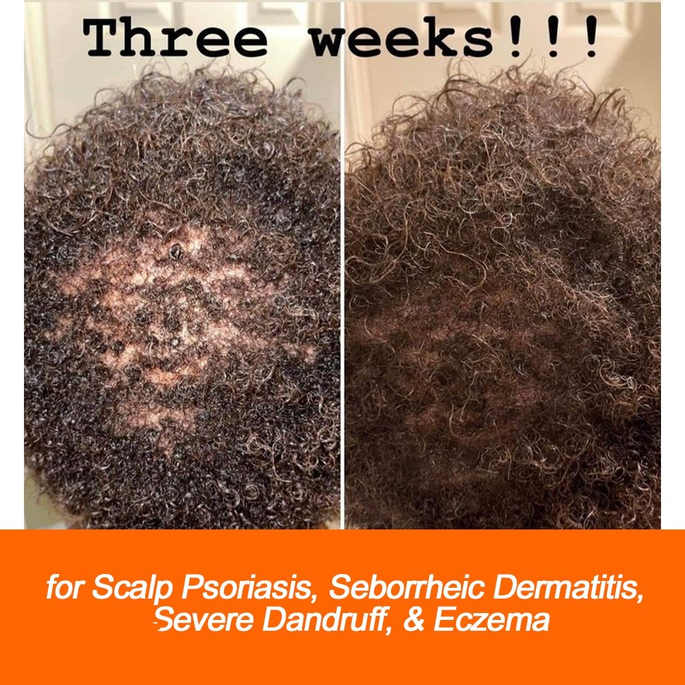 Psoriasis Shampoo Anti Itching Scalp Care Seborrheic Cream Repair Treatment Dandruff Hair Shampoo