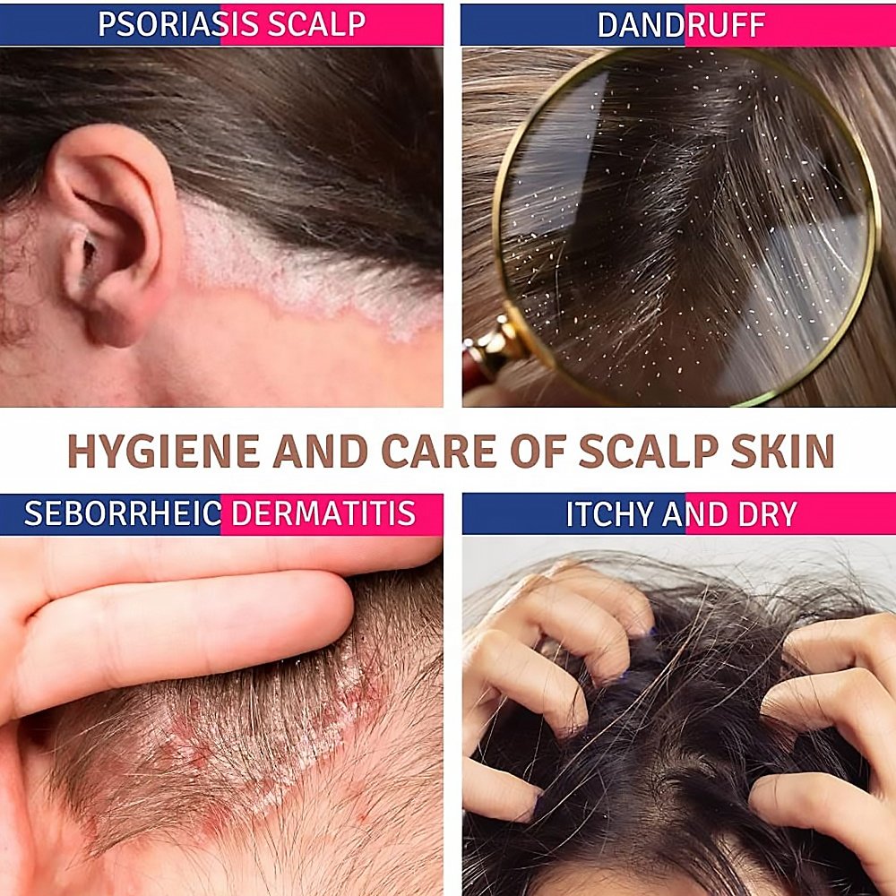 Psoriasis Shampoo Anti Itching Scalp Care Seborrheic Cream Repair Treatment Dandruff Hair Shampoo