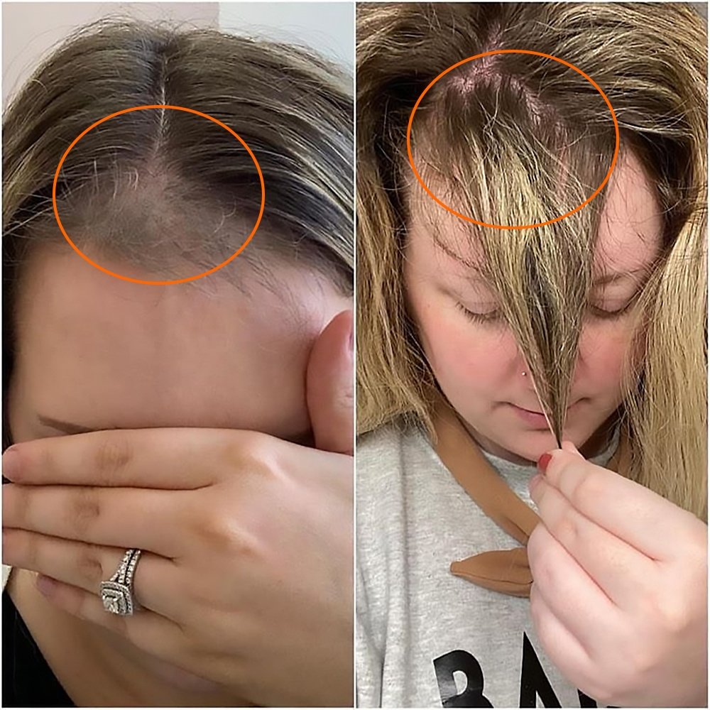 Psoriasis Shampoo Anti Itching Scalp Care Seborrheic Cream Repair Treatment Dandruff Hair Shampoo