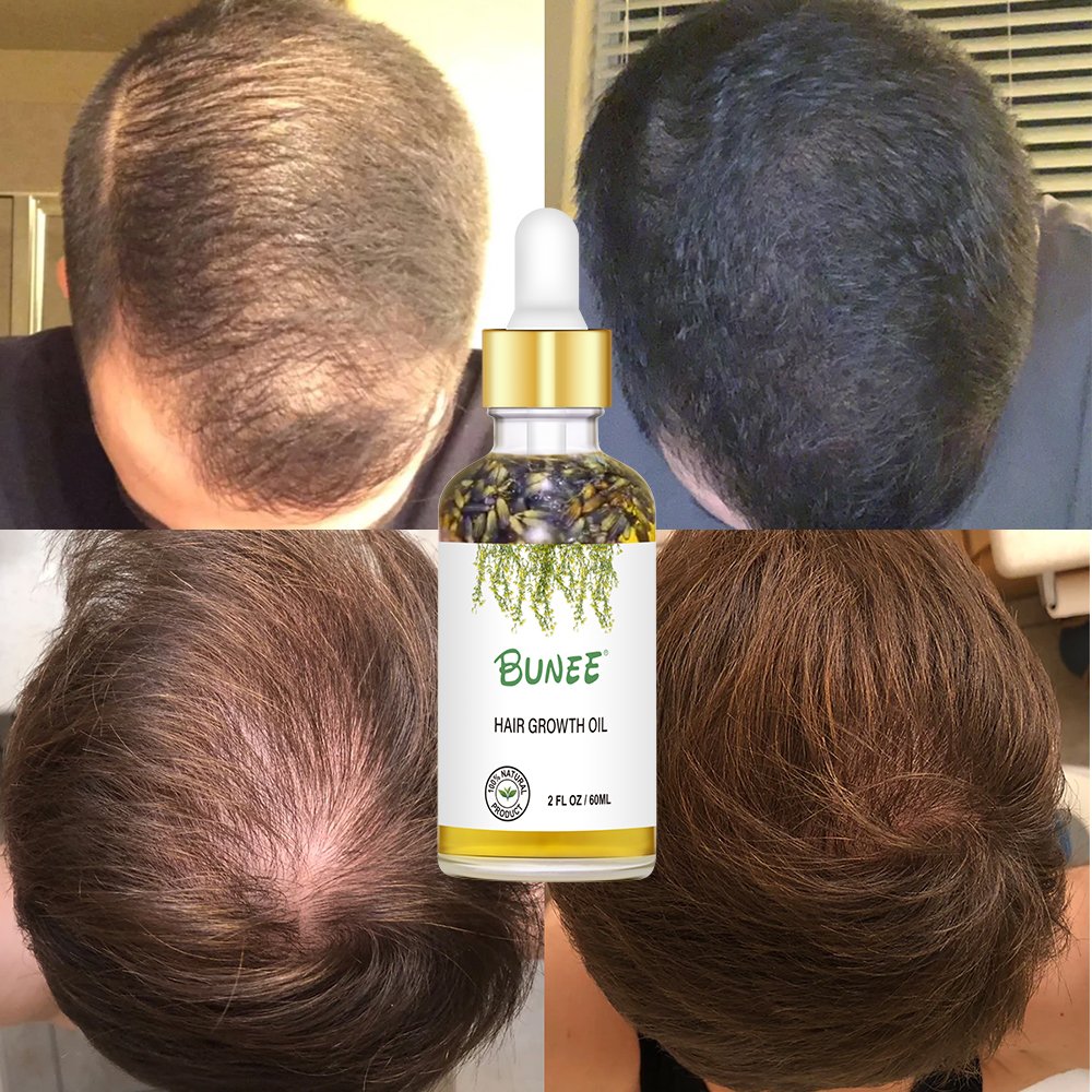 7days Fast effective Serum Factory Sell Fast Growth Wealth Hair Growth Lotion Hair Growth Scalp Serum