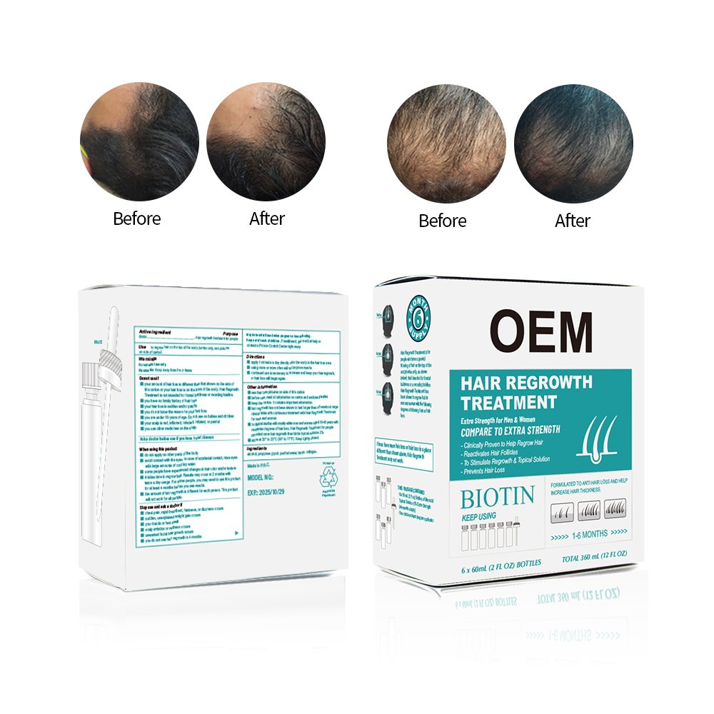 hair regrowth treatment for men