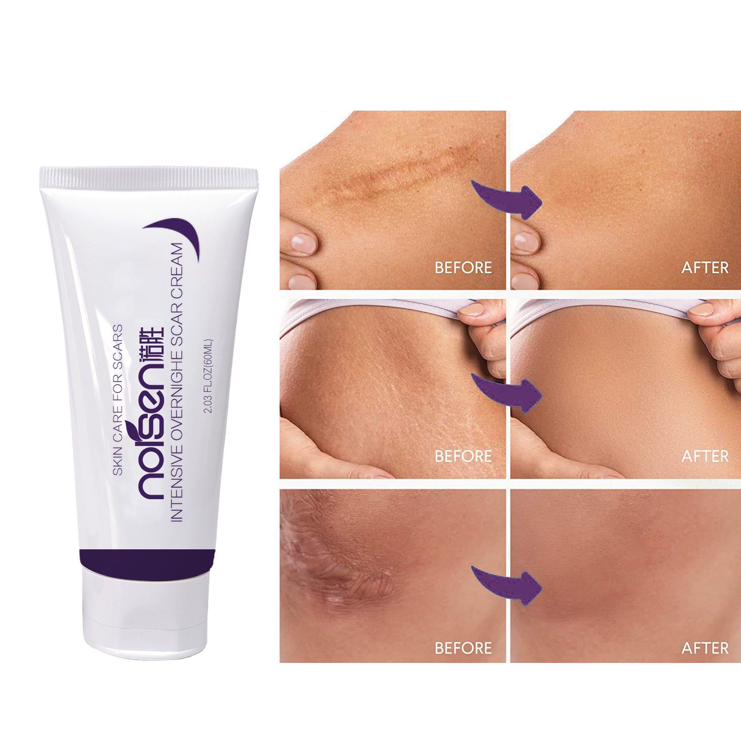 Private Label Organic Deep Scar Removing Treatment Repair Anti Pimples Marks Stretch Cream Acne Stretch Marks Scar Removal Cream