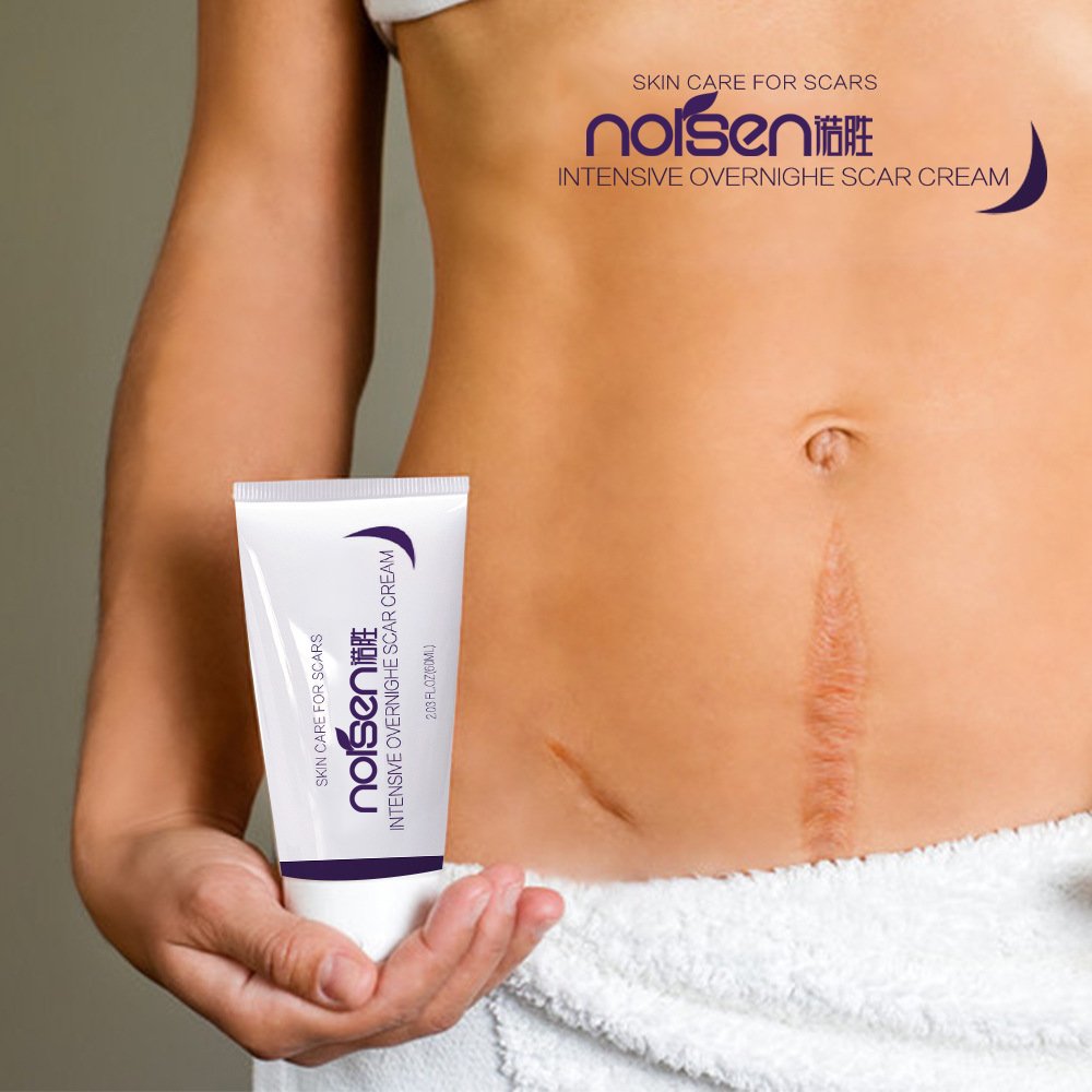 Private Label Organic Deep Scar Removing Treatment Repair Anti Pimples Marks Stretch Cream Acne Stretch Marks Scar Removal Cream